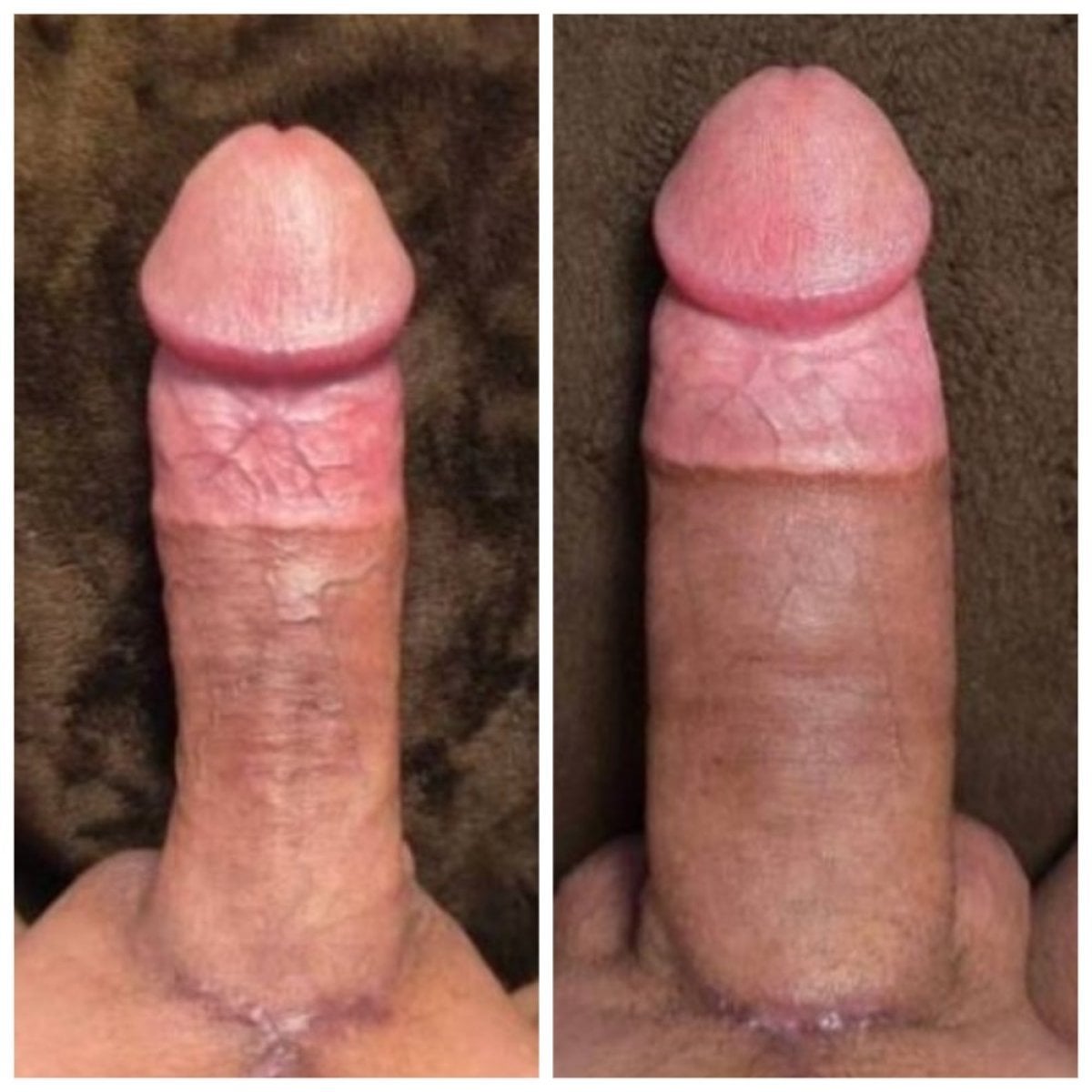 Resultados antes y después de aumento de pene en Eternity Clinic Phuket By Dr.Beer, aumento visible