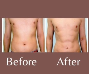 Before and after love handles liposuction result at ID Clinic Bangkok – improved waist contour
