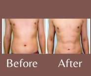 Before and after love handles liposuction result at ID Clinic Bangkok – improved waist contour