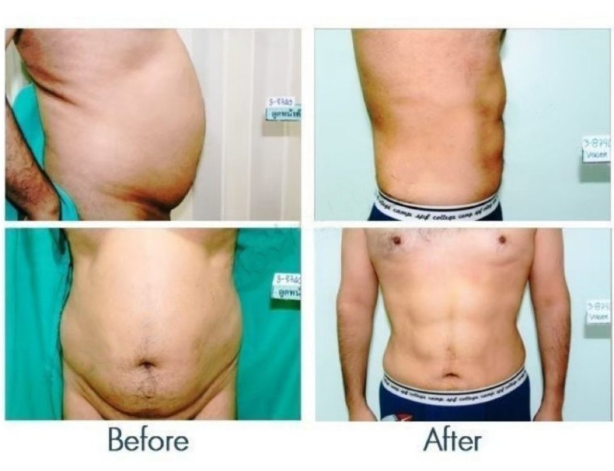 Antes y después de liposucción de flancos en ID Clinic Bangkok, resultado visible de contorno