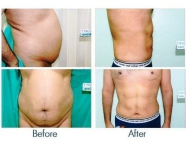Before and after love handles liposuction at ID Clinic Bangkok, visible body contouring result