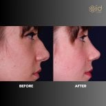 Before and after rhinoplasty results at ID Clinic Bangkok, improved nose shape and profile