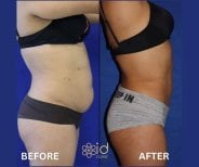 360 liposuction before and after results at ID Clinic Bangkok, visible body contour improvement