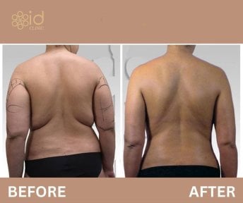 360 liposuction before and after results at ID Clinic Bangkok, visible back contour improvement