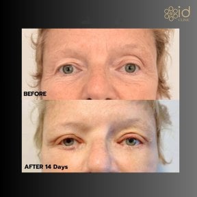 Before and after lower eyelid blepharoplasty results at ID Clinic Bangkok, 14 days post-op
