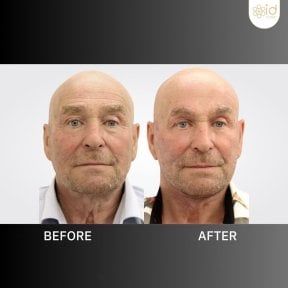 Before and after mini facelift results at ID Clinic Bangkok, visible facial rejuvenation effect