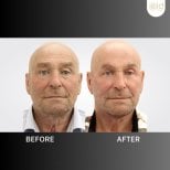 Before and after mini facelift results at ID Clinic Bangkok, visible facial rejuvenation effect