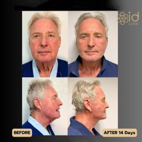 Deep plane facelift before and after results at ID Clinic Bangkok, visible facial rejuvenation