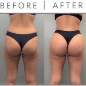 Before and after liposuction results at ID Clinic Bangkok, improved body contour and shape