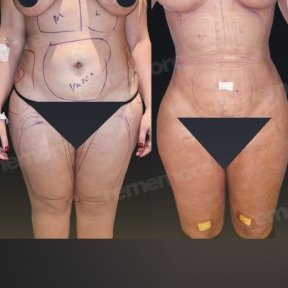 Vorher-nachher-Ergebnis Brazilian Butt Lift im Memorial Göztepe Hospital, verbesserte Körperform