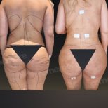 Vorher-nachher-Ergebnis Brazilian Butt Lift bei Memorial Göztepe Hospital, verbesserte Kontur