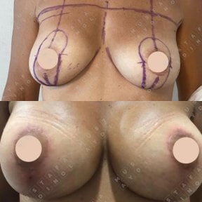 Before and after breast augmentation results at Dr. MED – enhanced breast shape and volume