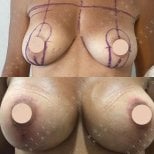 Before and after breast augmentation results at Dr. MED – enhanced breast shape and volume