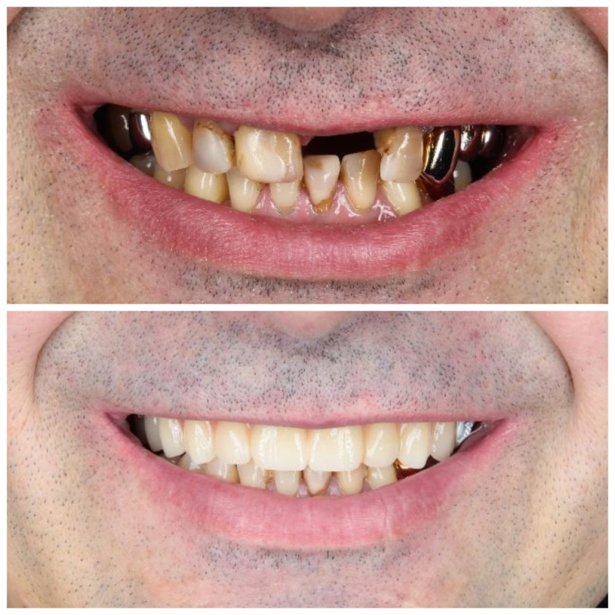 نتيجة قبل وبعد زراعة الأسنان All-on-4 في عيادة Dental Clinic Dynasty Stomatology كراكوف