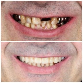 Before and after All-on-4 dental implants result at Dental Clinic Dynasty Stomatology Krakow