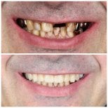 Before and after All-on-4 dental implants result at Dental Clinic Dynasty Stomatology Krakow