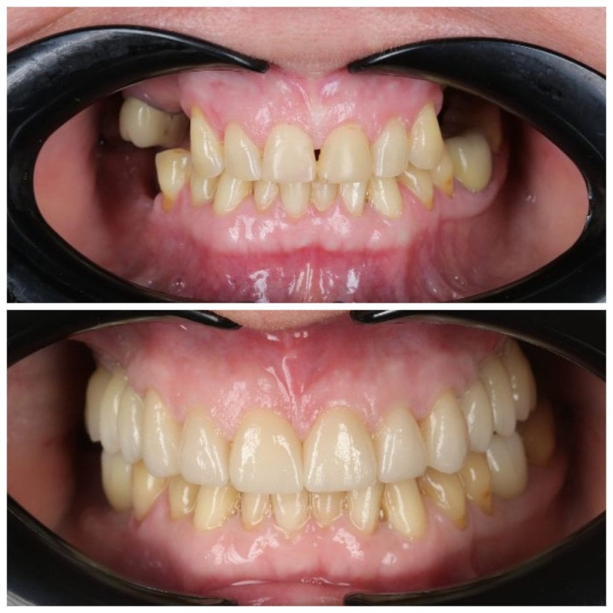 نتيجة قبل وبعد زراعة الأسنان All-on-4 في عيادة Dynasty Stomatology كراكوف