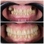 Before and after All-on-4 dental implants result at Dental Clinic Dynasty Stomatology Krakow