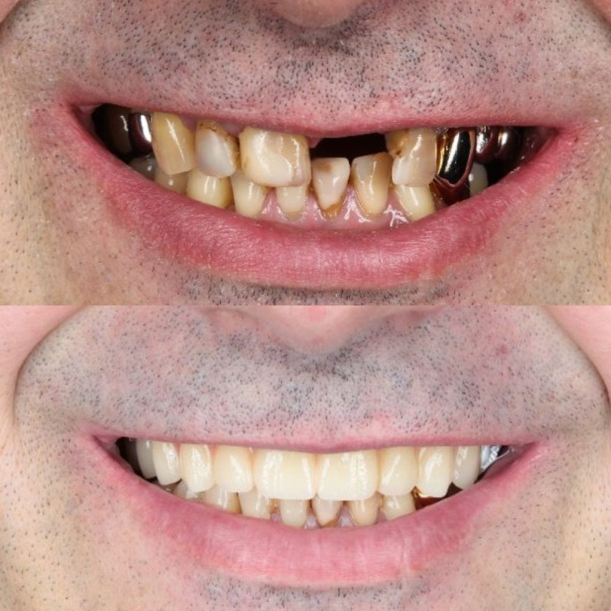 نتائج قبل وبعد زراعة الأسنان في عيادة Dynasty Stomatology في براغ