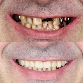 Vorher-nachher-Ergebnisse Zahnimplantat bei Dental Clinic Dynasty Stomatology in Prag