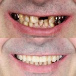 Vorher-nachher-Ergebnisse Zahnimplantat bei Dental Clinic Dynasty Stomatology in Prag