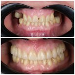 Vorher-nachher-Ergebnisse Zahnimplantat bei Dental Clinic Dynasty Stomatology in Prag