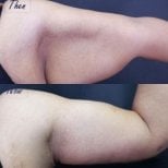 Before and after arm lift (brachioplasty) results at Asia Cosmetic Hospital, improved contour