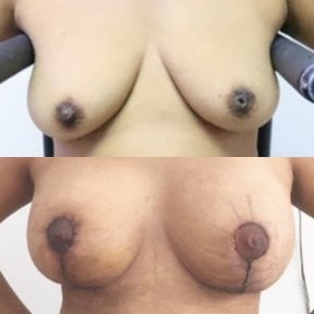 Before and after breast lift results at Asia Cosmetic Hospital, improved breast contour