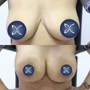 Before and after breast lift results at Asia Cosmetic Hospital, improved breast contour