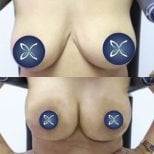 Before and after breast lift results at Asia Cosmetic Hospital, improved breast contour