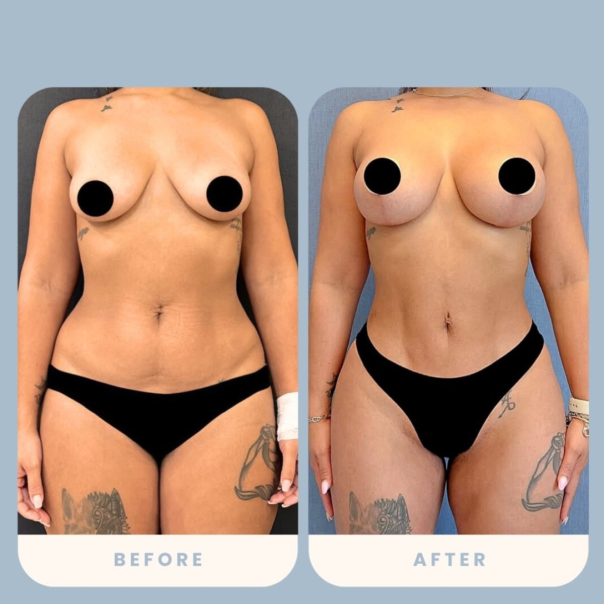 Antes y después de mastopexia con implantes en Estexper Clinic, mejora de forma mamaria