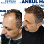 Resultados de trasplante capilar antes y después en Istanbul Hair Indonesia, línea restaurada