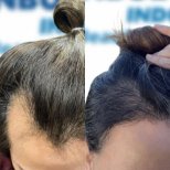 Resultados de trasplante capilar antes y después en Istanbul Hair Indonesia, mayor densidad