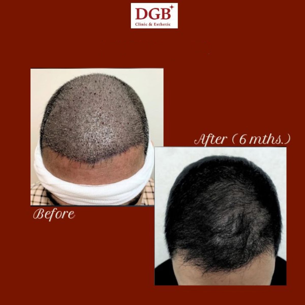 Antes y después de trasplante capilar en DGB Clinic – crecimiento visible tras 6 meses