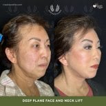 Before and after deep plane facelift and neck lift results at Medolea Clinic, facial rejuvenation