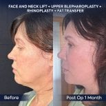 Before and after facelift, neck lift, blepharoplasty, rhinoplasty at Dr. Safa Manav Clinic result