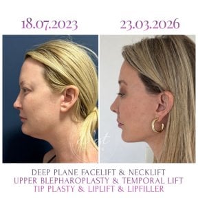 Before and after facelift, necklift, blepharoplasty, lip lift results at Db'est Clinic