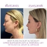 Before and after facelift, necklift, blepharoplasty, lip lift results at Db'est Clinic