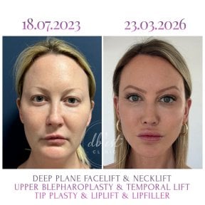 Before and after facelift, blepharoplasty, and lip filler results at Db'est Clinic