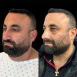 Resultados de rinoplastia antes y después en Dr. Michel Salameh - Plastic And Aesthetic Surgery
