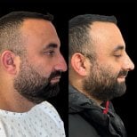 Resultados de rinoplastia antes y después en Dr. Michel Salameh - Plastic And Aesthetic Surgery