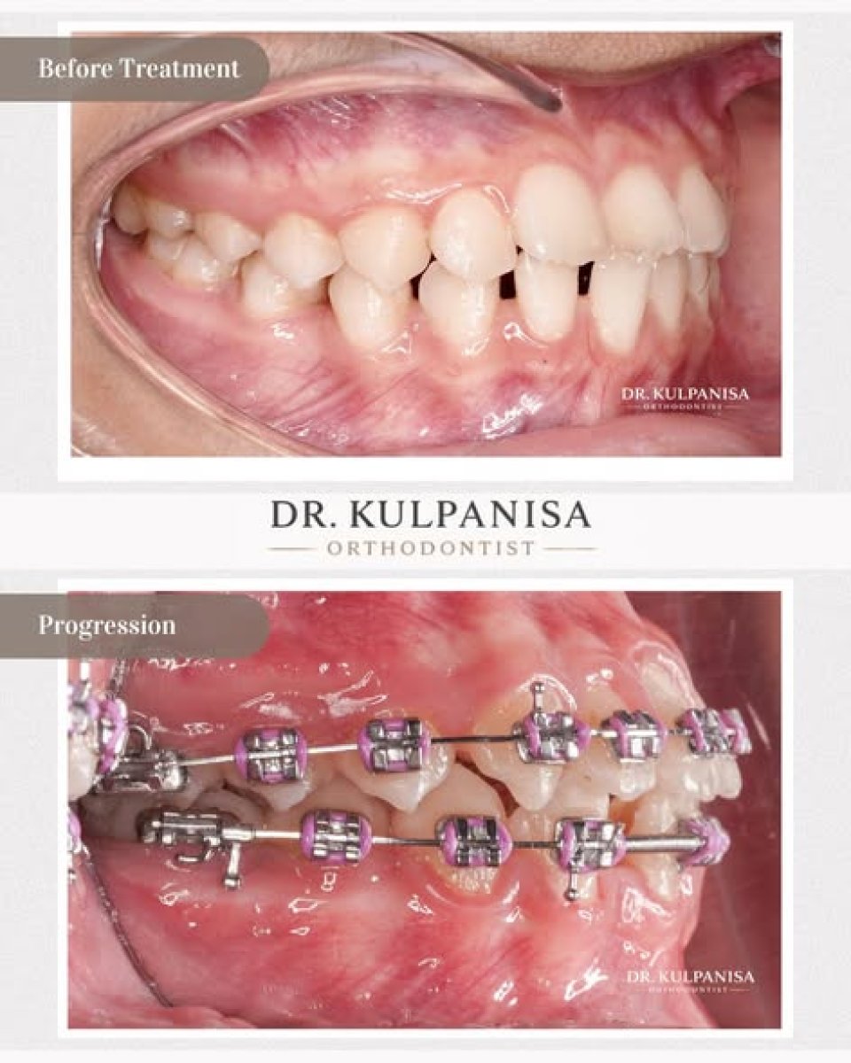 Progreso del tratamiento con brackets Damon en Bangkok Dental Hospital, mejora de alineación dental