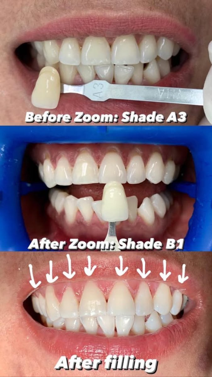 نتائج الحشو التجميلي وتبييض الأسنان في مستشفى بانكوك لطب الأسنان، ابتسامة أكثر إشراقًا
