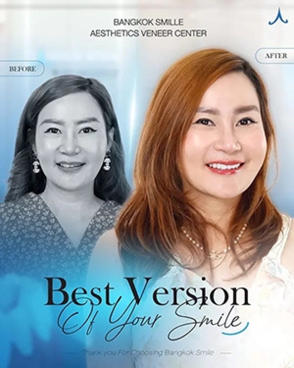 نتيجة قبل وبعد فينير إيماكس في Bangkok Smile Dental Group، تحول الابتسامة
