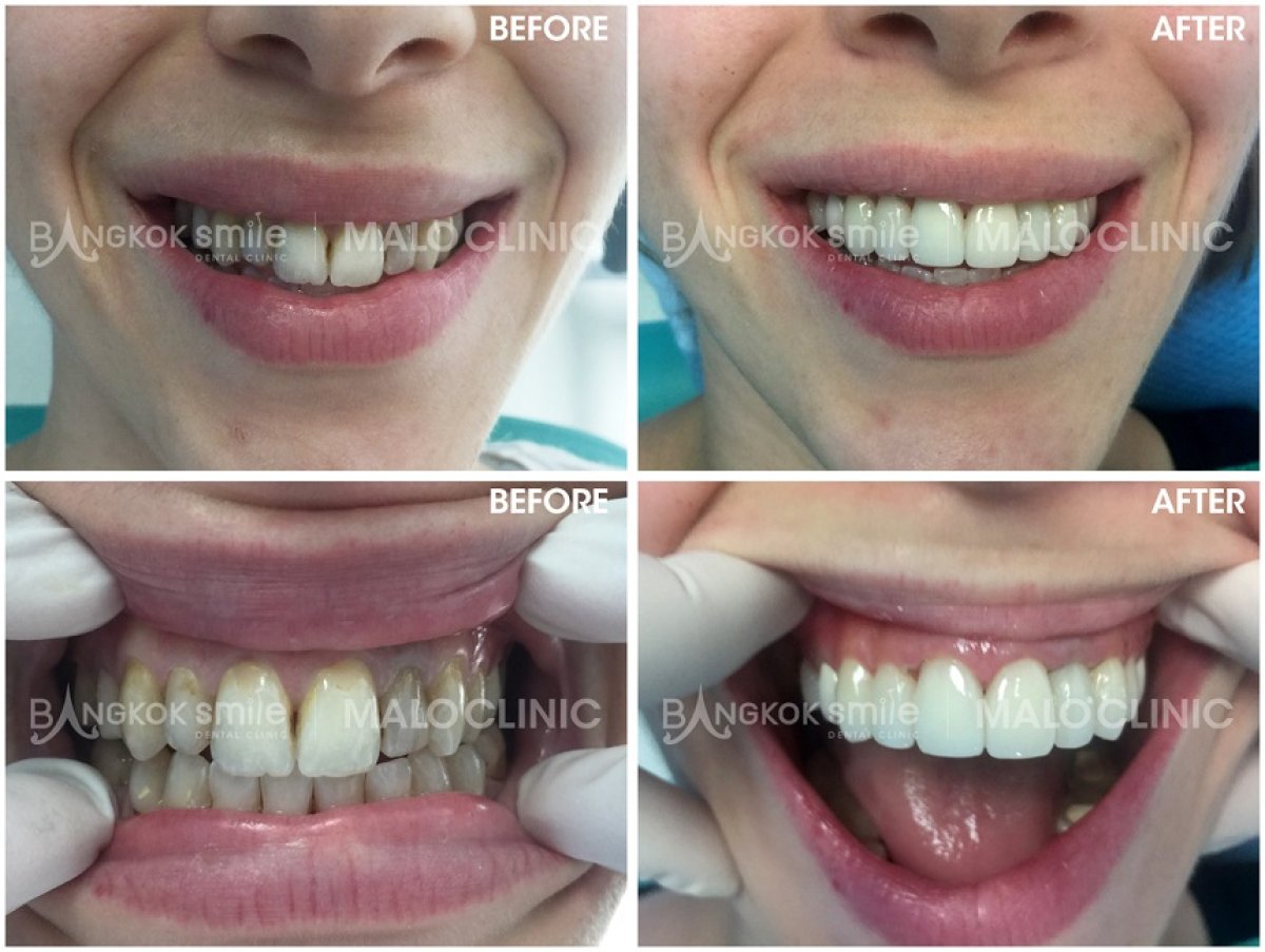 نتائج قبل وبعد قشور البورسلين في Bangkok Smile Dental Group، تحول ملحوظ للابتسامة