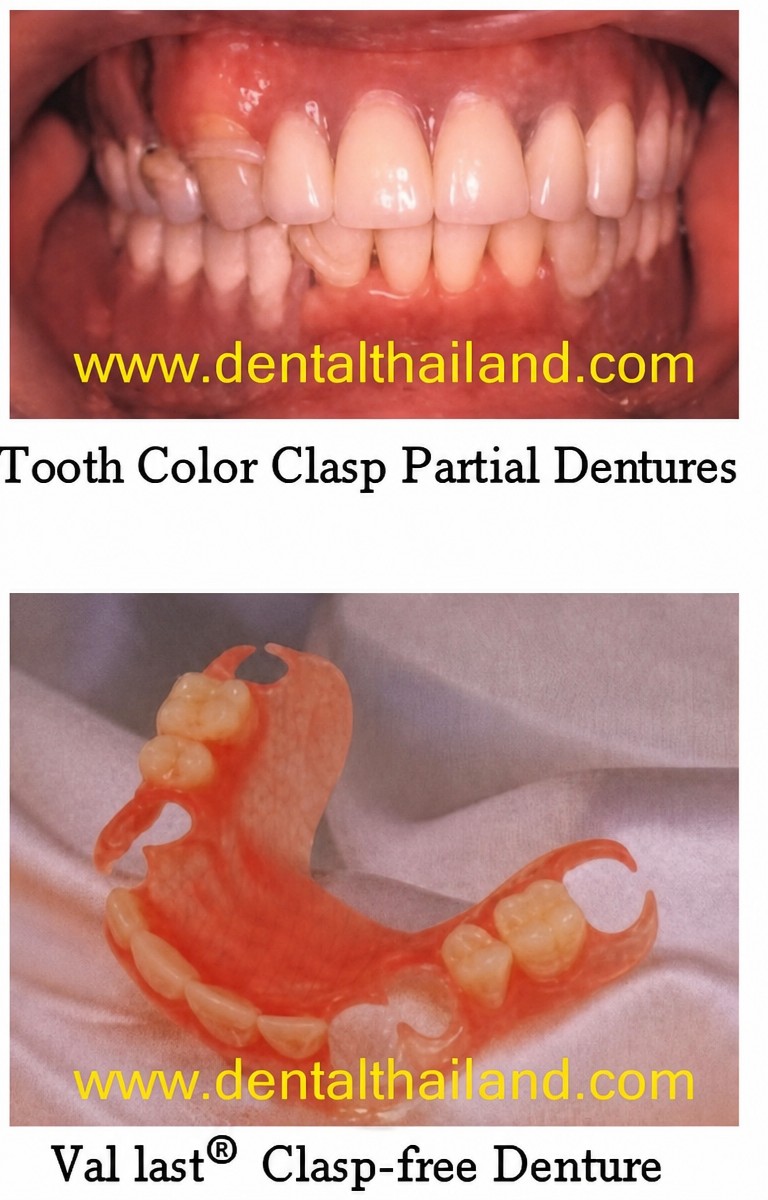 نتائج طقم الأسنان الجزئي في Bangkok Smile Dental Group – بخيارات مع أو بدون مشابك