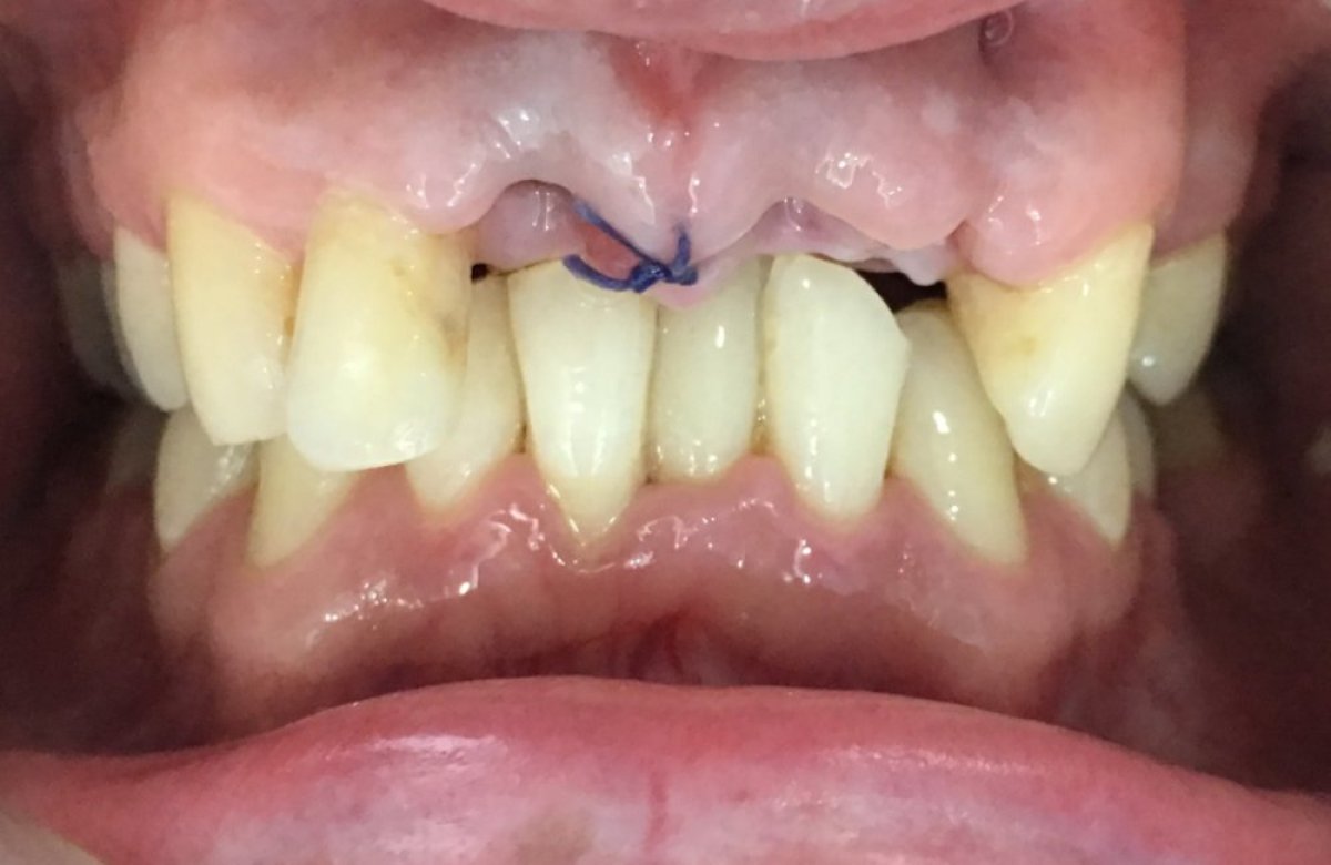 Resultado de cirugía de encías en Bangkok Smile Dental Group, puntos visibles y encía en curación