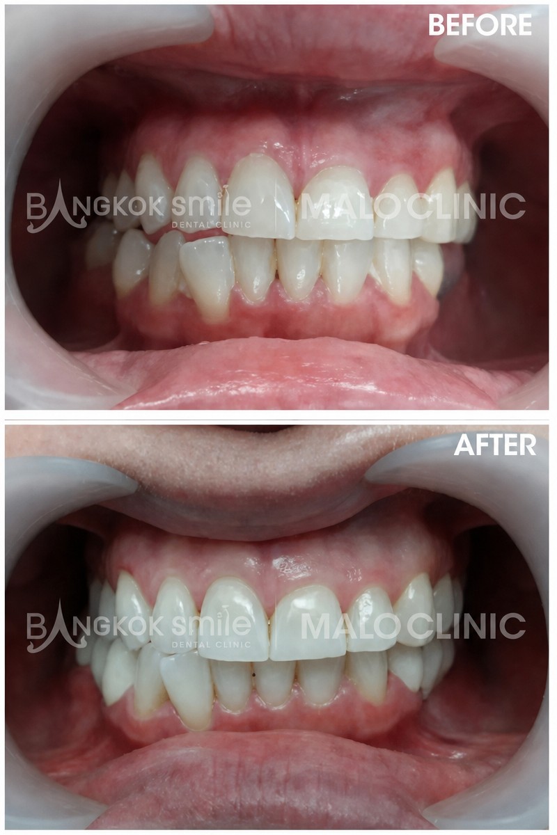 نتائج تقويم الأسنان قبل وبعد في Bangkok Smile Dental Group، تحسين انتظام الأسنان
