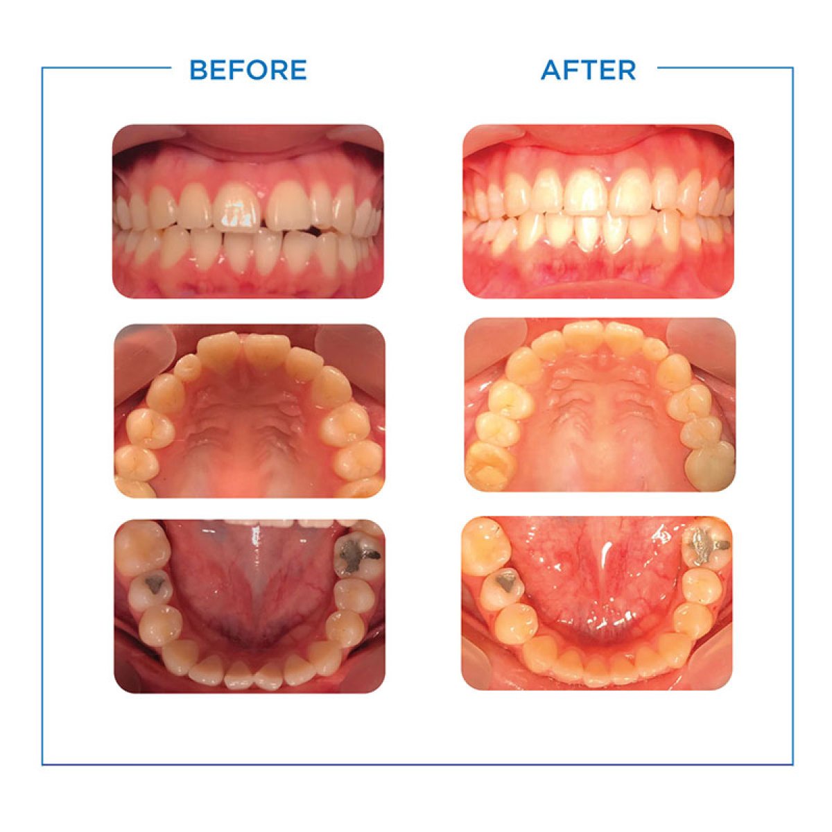 نتائج قبل وبعد تقويم الأسنان في Bangkok Smile Dental Group، تحسين انتظام الأسنان