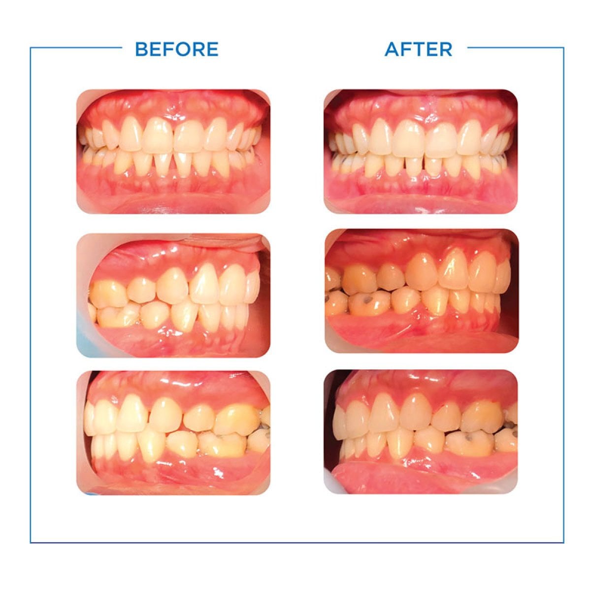 نتائج تقويم الأسنان قبل وبعد في Bangkok Smile Dental Group، تحسين انتظام الأسنان